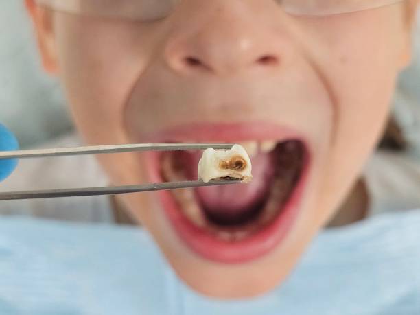 Best Emergency Dentist for Lost Fillings or Crowns in New Deal, TX